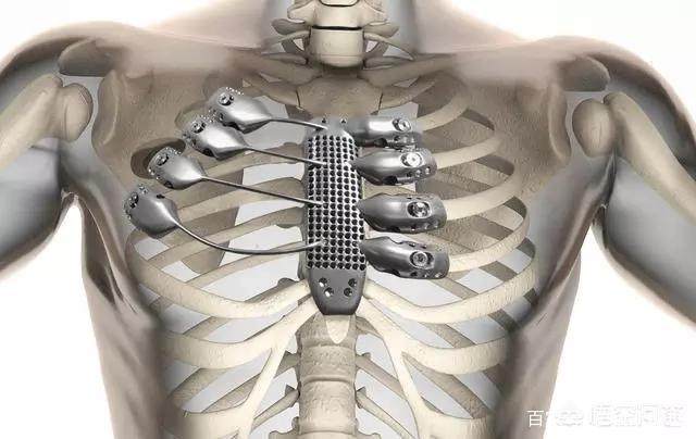 如果把人身上的骨头全换成钛合金，会发生什么事？